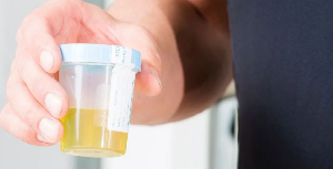 Urine Cancer.png