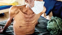 File photo: A TB patient