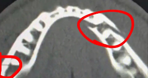 The YouTuber spat out a mouthful of blood during his post-fight interview