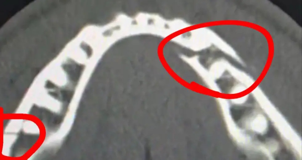 The YouTuber spat out a mouthful of blood during his post-fight interview