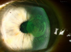 File photo: Glaucoma infected eye