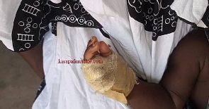 11-month-old boy whose hands were chopped off