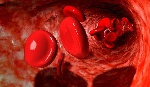 Dr Bankas said more than 400,000 babies are born with sickle cell disease globally each year