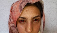 Dis Afghan woman get back her sight afta her earthquake injury