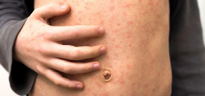 Health experts warn measles spreads very easily and can cause serious health complications
