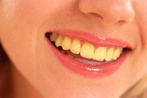 Causes of yellow teeth