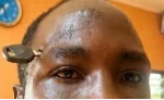Doctors successfully remove motorbike key from farmer’s skull