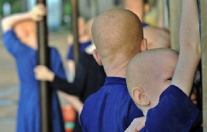 Worldwide, it is estimated that one in 20,000 people are affected by albinism
