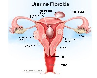 Diagram showing uterine fibroids
