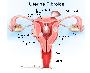 Diagram showing uterine fibroids