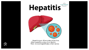 Hepatitis B is a viral infection that impacts the liver