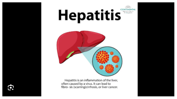 Hepatitis B is a viral infection that impacts the liver