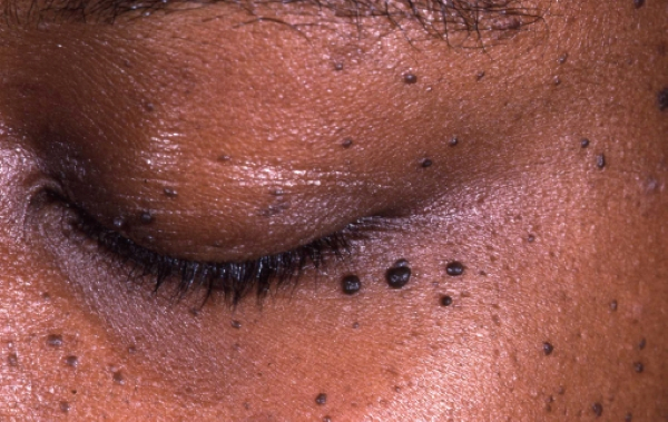 Almost every Ghanaian has a disease called Kookoo, according to our local home-made doctors