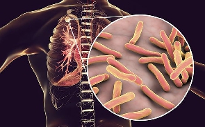 File photo of respiratory disease, tuberculosis