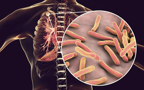 Persons with Tuberculosis are at higher risk of contracting the COVID-19