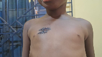The 5-year-old girl was allegedly inflicted with blade wounds on the chest by a nursing mother