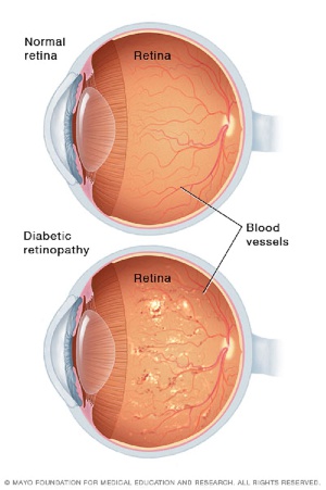 A healthy retina and a retina with Diabetic Retinopathy