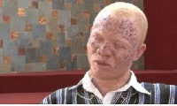 Newton Kweku Katseku, Executive Director of the Ghana Association of Persons with Albinism