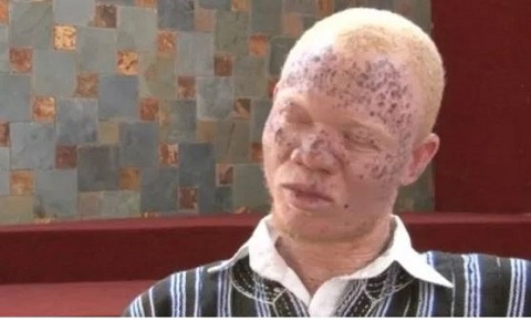 Newton Kweku Katseku, Executive Director of the Ghana Association of Persons with Albinism