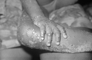 Victim showing signs of monkey pox disease