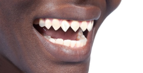 Teeth can naturally regenerate dentine without assistance, but only under certain circumstances