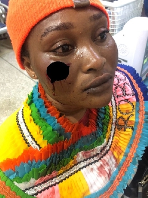 Roberta Monkah said she has been left with wounds under her right eye following the assault