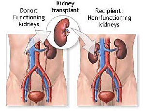 Kidneytransplant