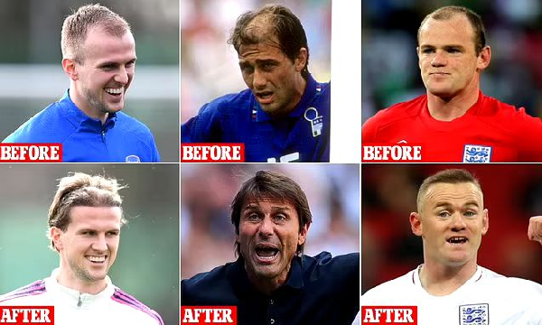 A photo of football stars who transformed their look with hair transplants
