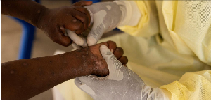 A nurse takes a sample from a child declared a suspected case of Mpox