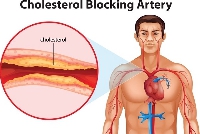 How Cholesterol affects the artery