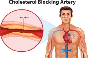 How Cholesterol affects the artery