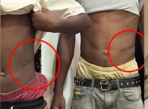 Lawyer alleges Abuja kidney victim was paid about N1.5m after the organ was harvested