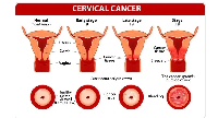 According to the Global cancer observatory, cervical cancer was the third highest in cancers in 2020