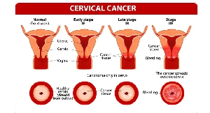According to the Global Cancer Observatory, cervical cancer was the third highest cancer rate in 2020