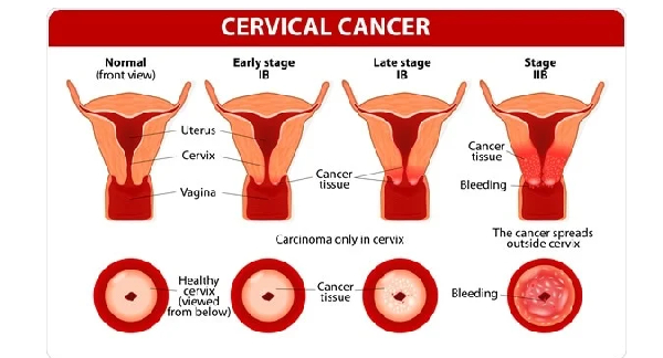 According to the Global cancer observatory, cervical cancer was the third highest in cancers in 2020