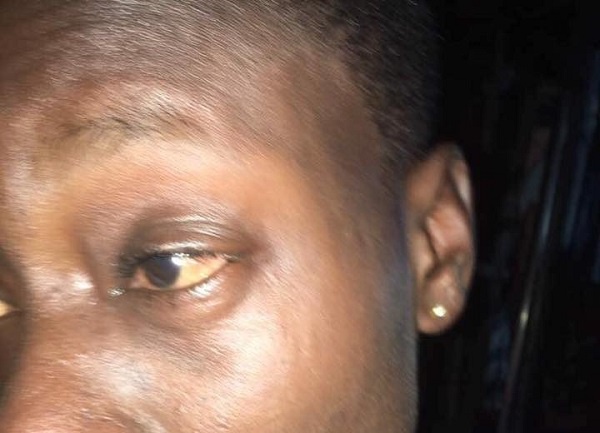KONA Bar Bouncer slapped Ms Portia Asantewa Duah twice across the face leaving her eyes swollen