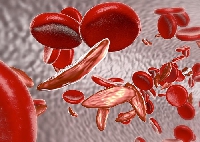 Sickle Cell.  File photo