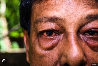 Conjunctivitis, or pink eye, is an irritation or inflammation of the conjunctiva