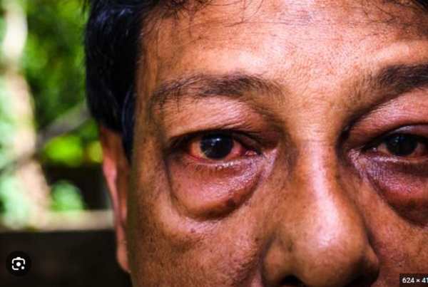 Conjunctivitis, or pink eye, is an irritation or inflammation of the conjunctiva