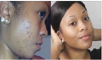 Before and After treatment