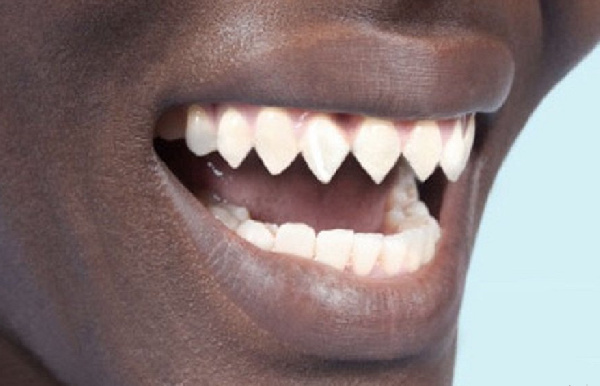 sharp human teeth