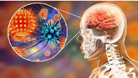 Meningitis is inflammation of the protective membranes (meninges) around the brain and spinal cord