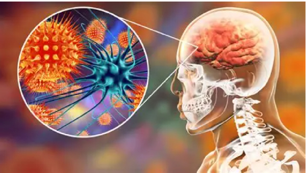 Meningitis is inflammation of the protective membranes (meninges) around the brain and spinal cord