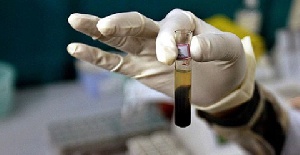 In 2023 Cameroon reported 12,000 new cases of hepatitis B