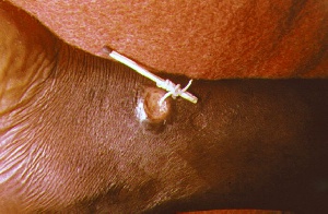 File photo of guinea worm disease