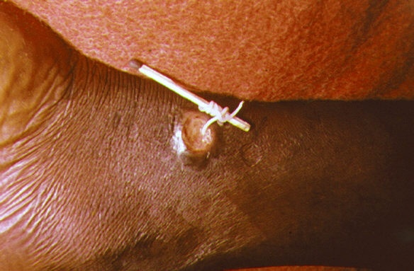 File photo of guinea worm disease