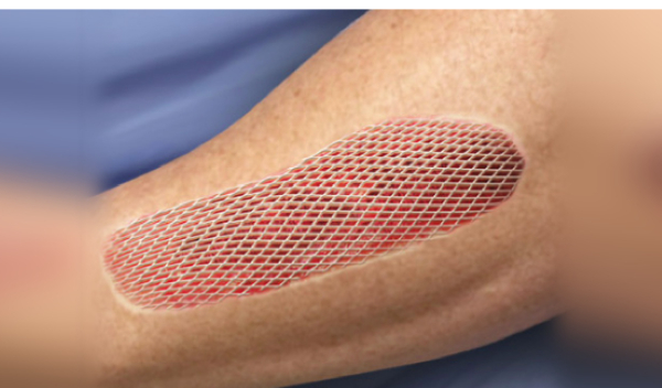 A photo dipicting skin grating