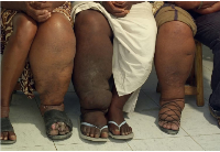 Photo of people with elephantiasis