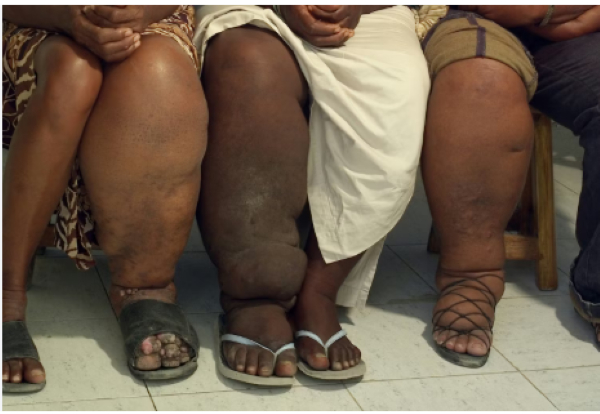 Photo of people with elephantiasis