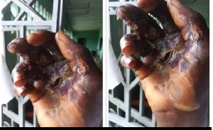 File photo of a person's burnt hands